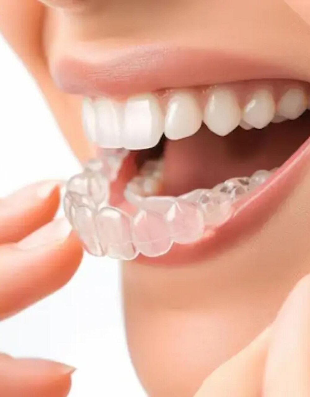 Invisalign Package