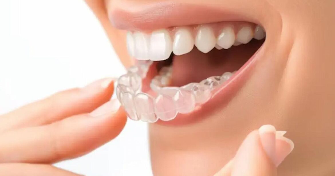 Invisalign Package
