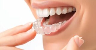 Invisalign Package