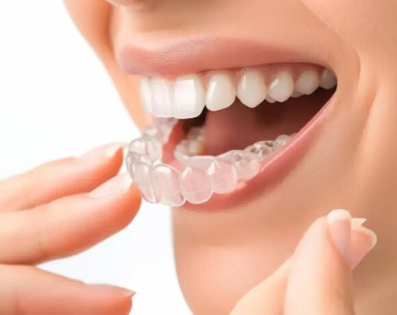 Invisalign Package